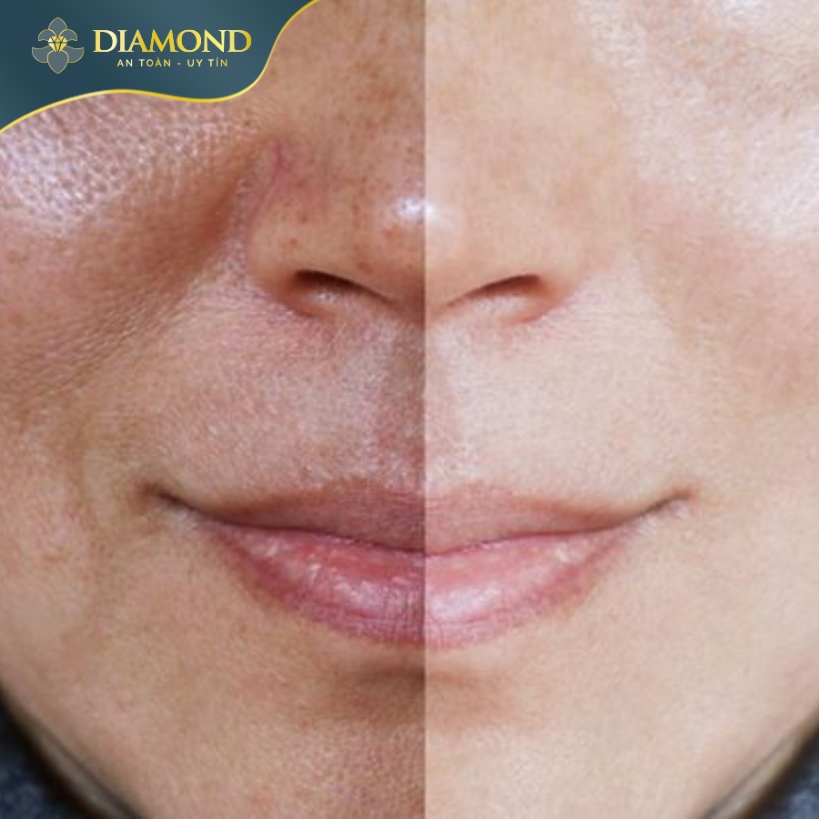 Kết quả điều trị nám mùa thu - đông giảm nguy cơ nám tái phát, tạo điều kiện thuận lợi cho quá trình điều trị hiệu quả