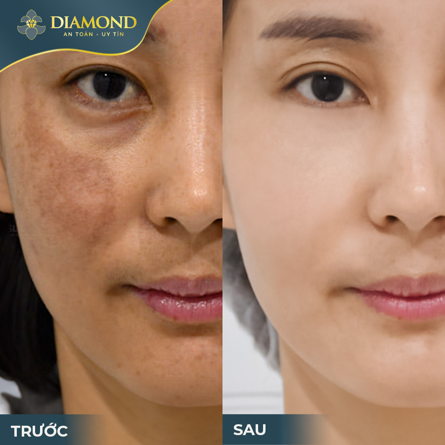 Hình ảnh khách hàng sau khi điều trị nám tàn nhang sau 1 liệu trình