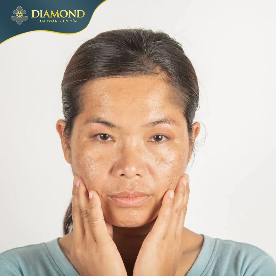 Nám da làm nhiều chị em trông già đi và làn da sạm màu hơn