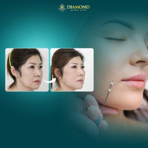 Phương pháp đặt chỉ giúp căng bóng da, trẻ hóa gương mặt toàn diện