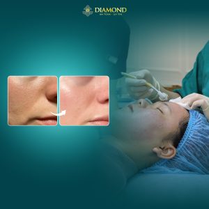 Phương pháp lăn kim giúp tăng sinh collagen, mờ thâm nám, sẹo rỗ, se khít lỗ chân lông