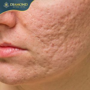 Sẹo thâm, sẹo rỗ do mụn khó phục hồi, khiến da sần sùi, xấu xí