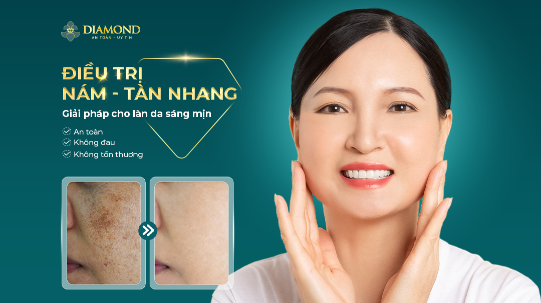 Nám tàn nhang là gì? Giải pháp cho làn da sáng mịn