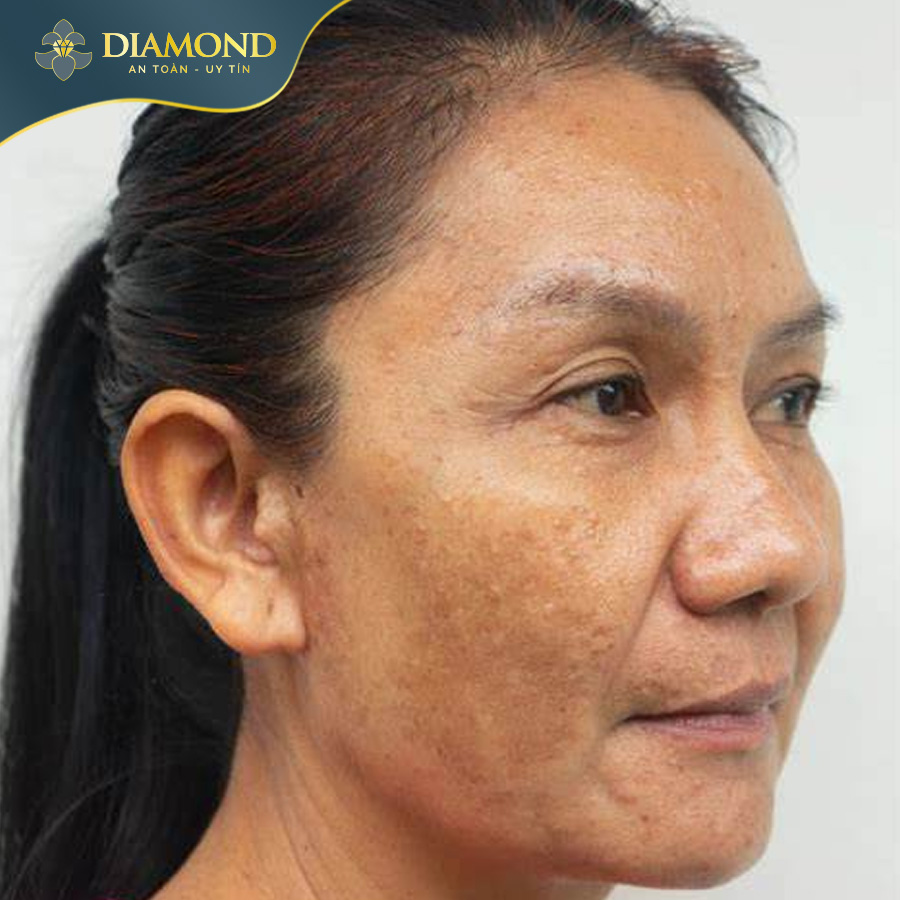 Nám da - kẻ thù âm thầm, làm mờ đi vẻ đẹp và sự tự tin của nhiều chị em phụ nữ.