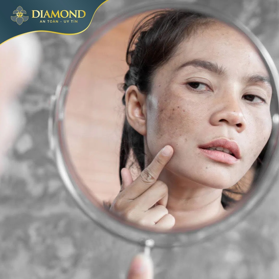 nám da nghiêm trọng hơn nếu không điều trị sớm