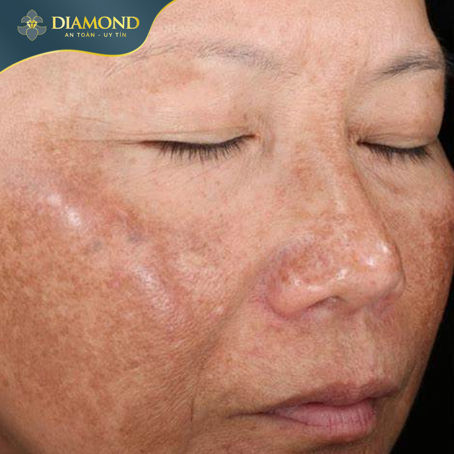 Nám không phải là một vấn đề sức khỏe nghiêm trọng, nhưng  tác động đáng kể đến vẻ đẹp bề ngoài