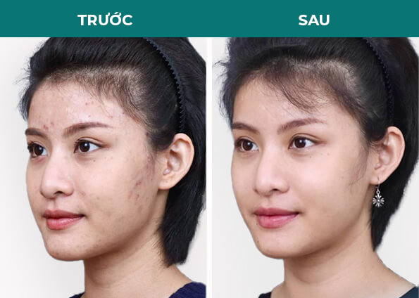khách hàng ảnh trước sau trị mụn