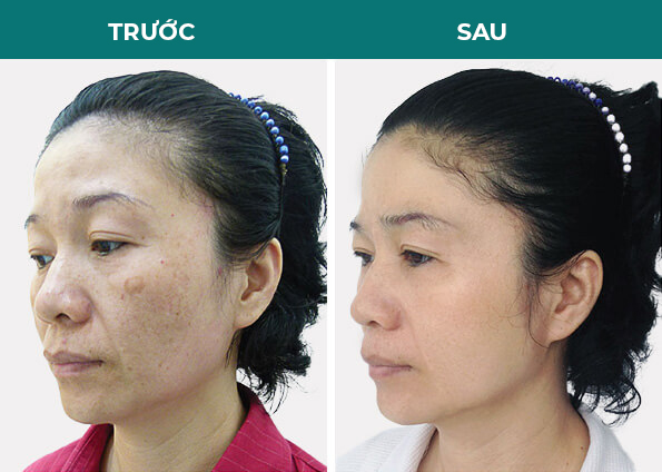 khách hàng ảnh trước sau trị tàng nhang