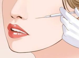 Tiêm chất làm đầy nâng cơ táo